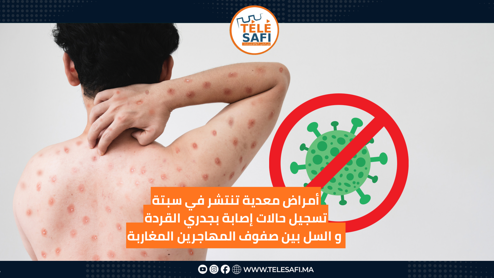 أمراض معدية تنتشر في سبتة تسجيل حالات إصابة بجدري القردة و السل بين صفوف المهاجرين المغاربة